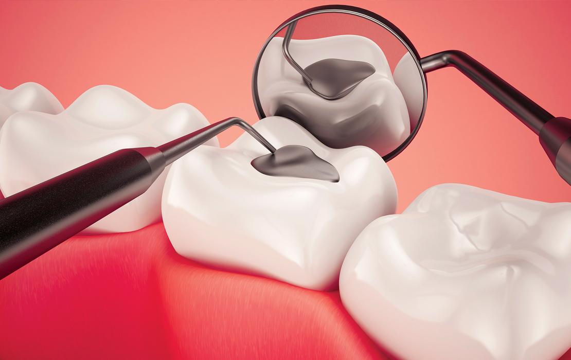 dental fillings