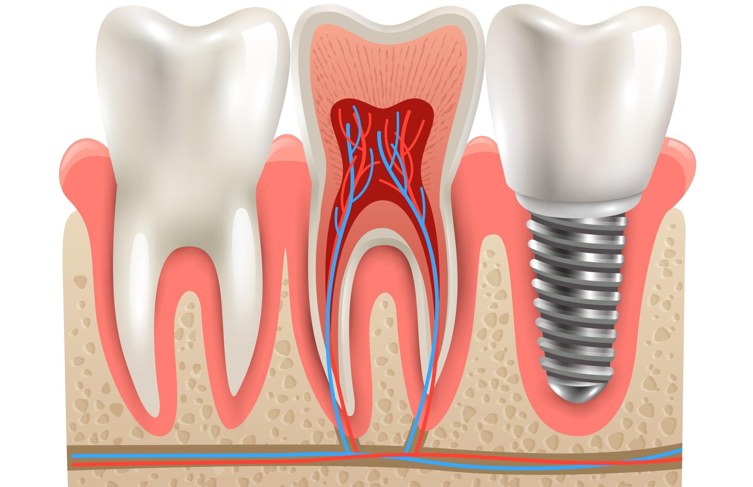 زراعة الاسنان